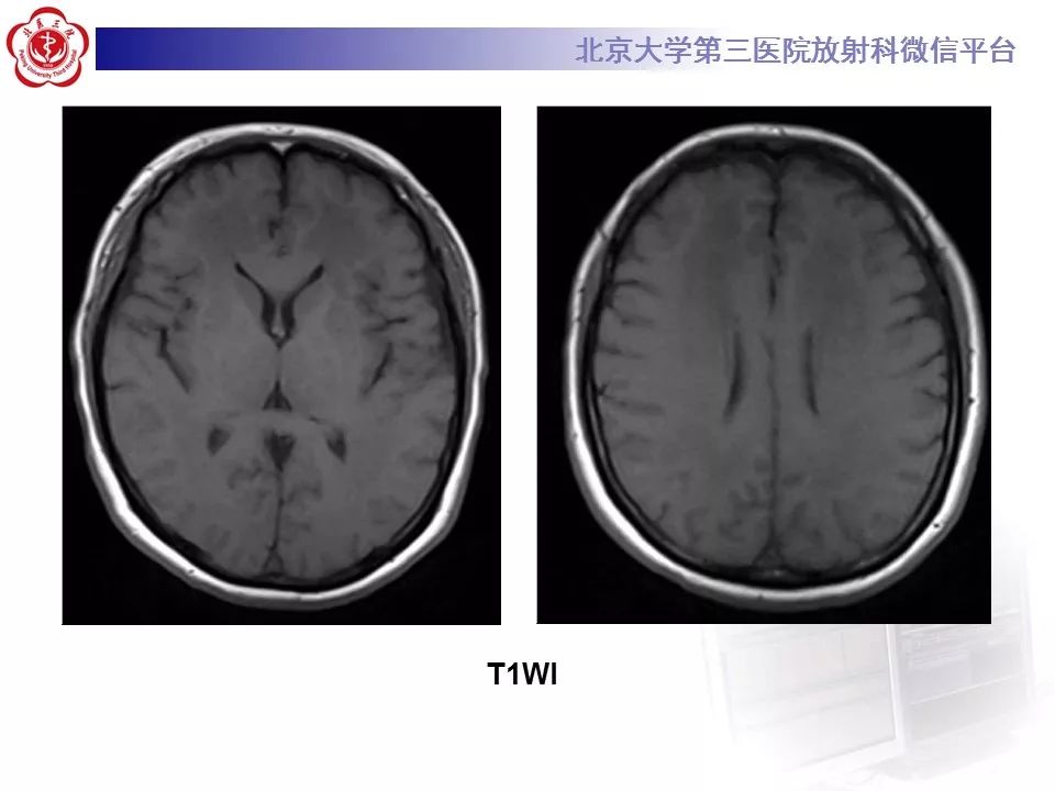 【病例】急性一氧化碳中毒迟发性脑病1例MR影像诊断