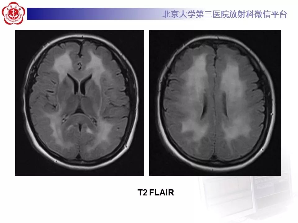 【病例】急性一氧化碳中毒迟发性脑病1例MR影像诊断