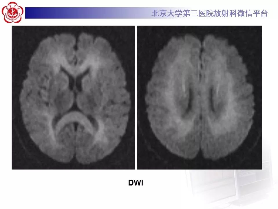 【病例】急性一氧化碳中毒迟发性脑病1例MR影像诊断