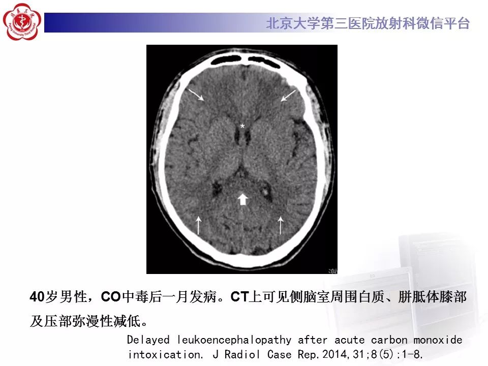 【病例】急性一氧化碳中毒迟发性脑病1例MR影像诊断