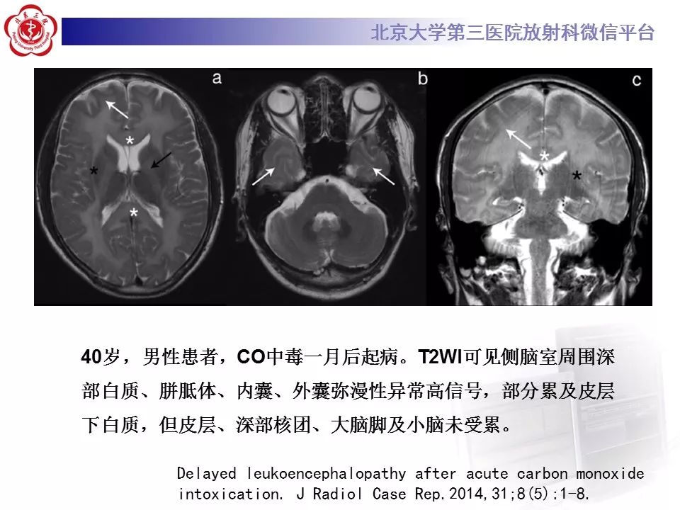 【病例】急性一氧化碳中毒迟发性脑病1例MR影像诊断