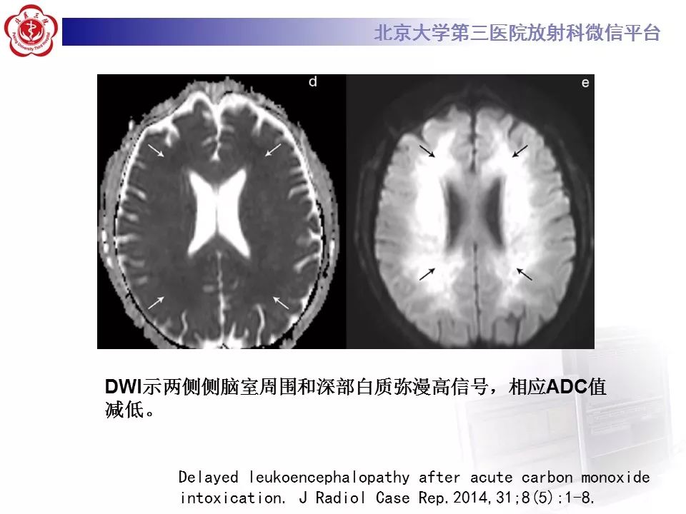 【病例】急性一氧化碳中毒迟发性脑病1例MR影像诊断