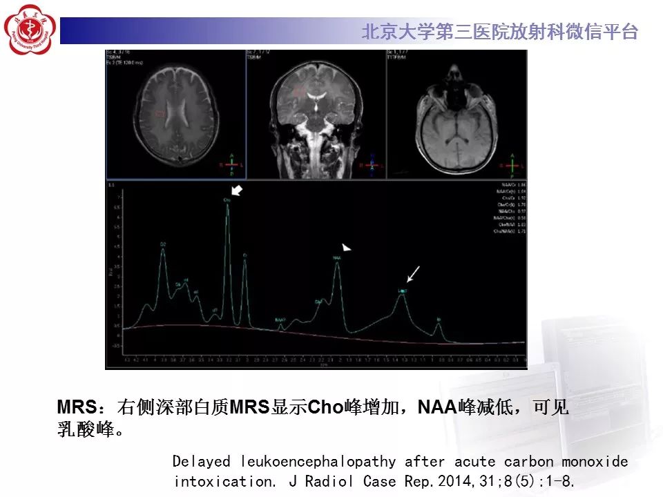 【病例】急性一氧化碳中毒迟发性脑病1例MR影像诊断