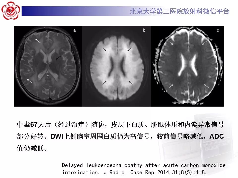【病例】急性一氧化碳中毒迟发性脑病1例MR影像诊断