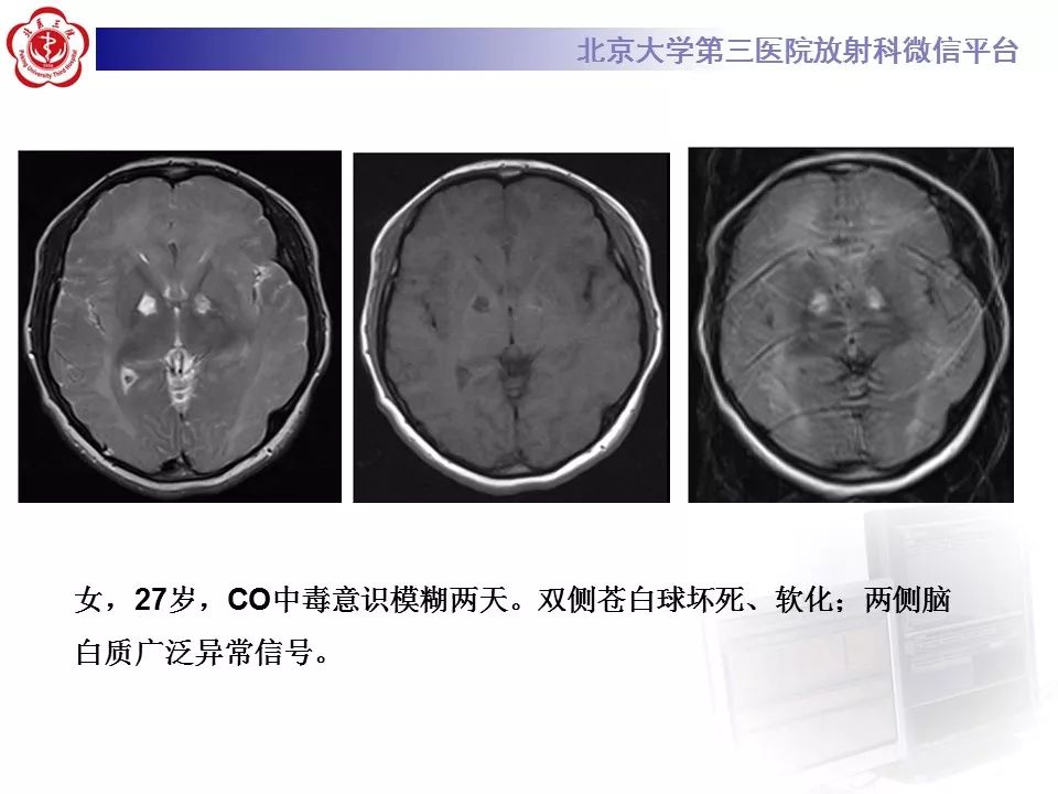 【病例】急性一氧化碳中毒迟发性脑病1例MR影像诊断
