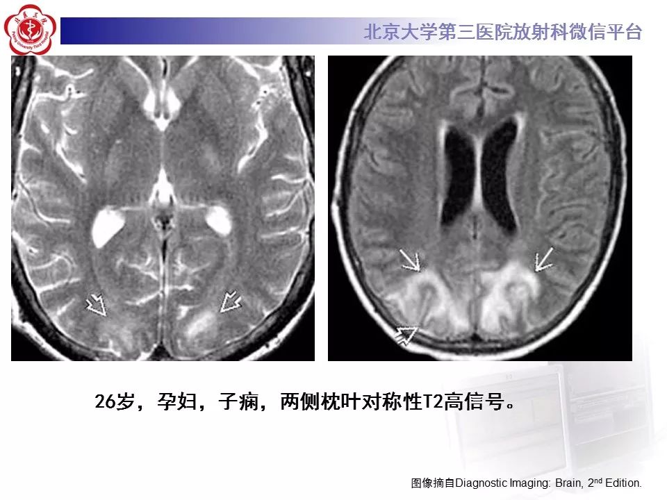 【病例】急性一氧化碳中毒迟发性脑病1例MR影像诊断