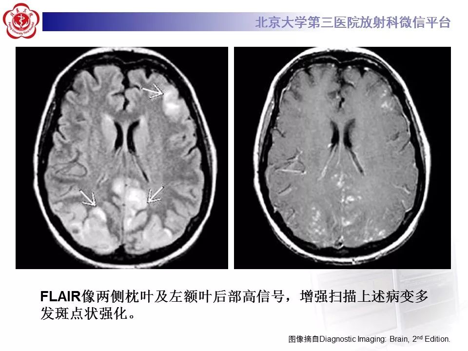 【病例】急性一氧化碳中毒迟发性脑病1例MR影像诊断