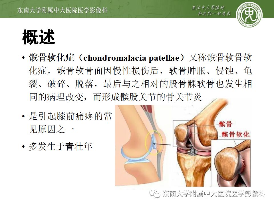 【病例】髌骨软化症1例MR影像诊断