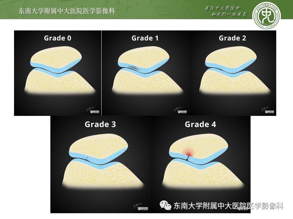 【病例】髌骨软化症1例MR影像诊断