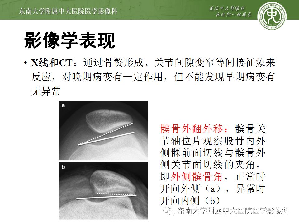 【病例】髌骨软化症1例MR影像诊断