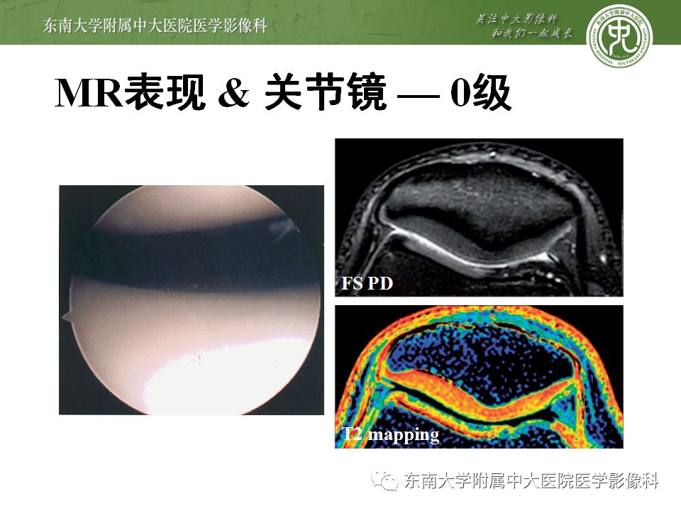 【病例】髌骨软化症1例MR影像诊断