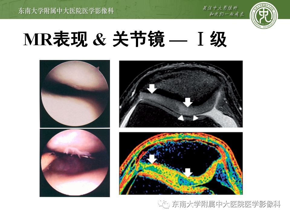 【病例】髌骨软化症1例MR影像诊断