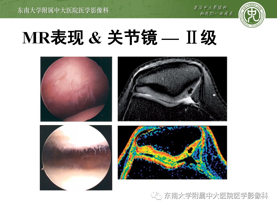 【病例】髌骨软化症1例MR影像诊断