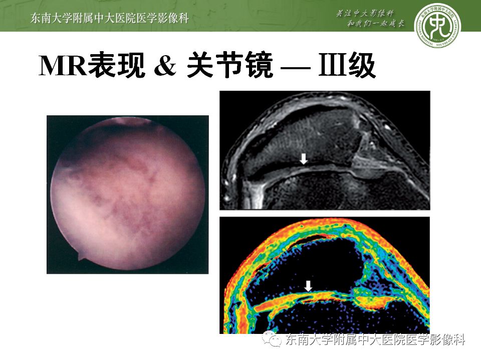 【病例】髌骨软化症1例MR影像诊断