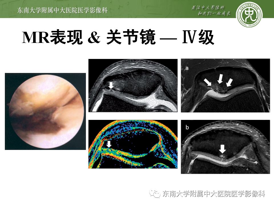 【病例】髌骨软化症1例MR影像诊断