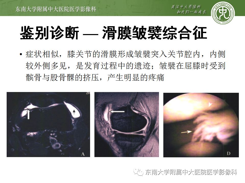 【病例】髌骨软化症1例MR影像诊断