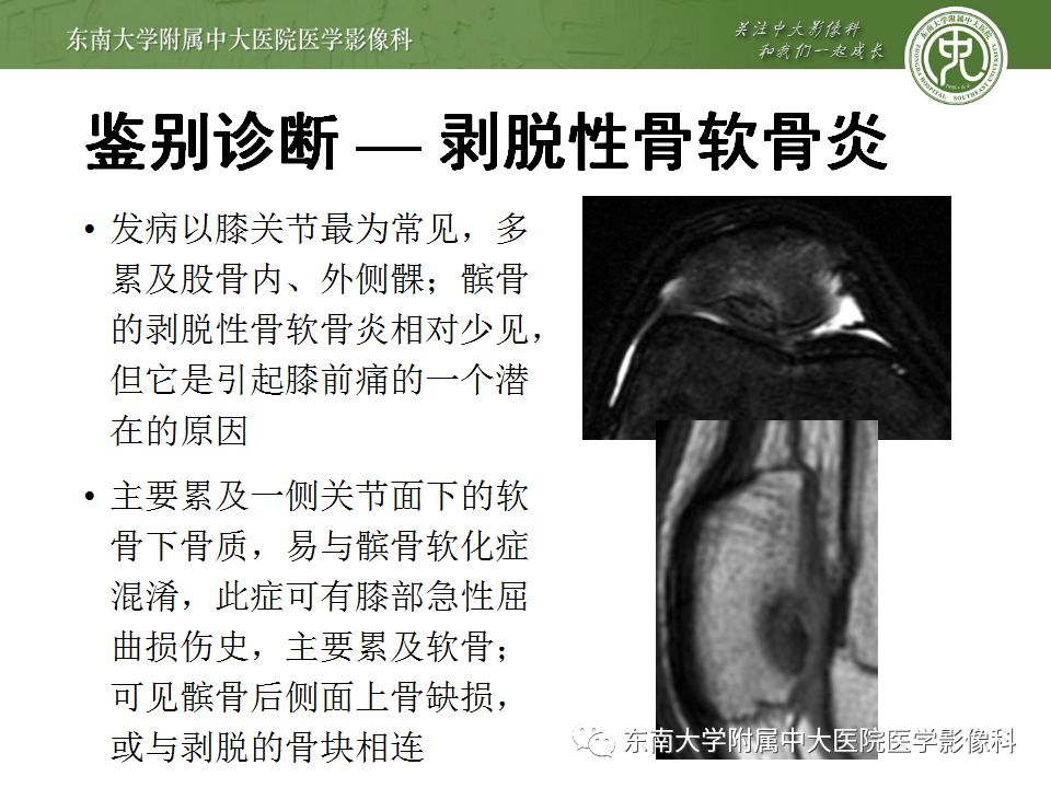 【病例】髌骨软化症1例MR影像诊断