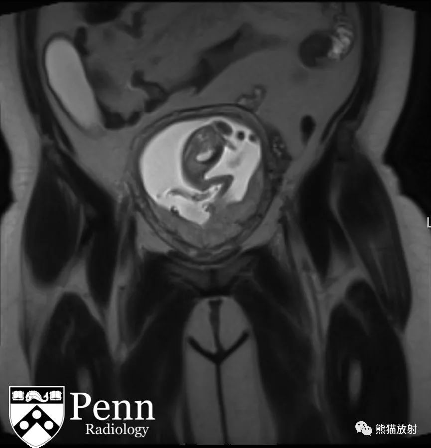【病例】阑尾黏液囊肿1例MR影像表现 【病例】阑尾黏液囊肿1例MR影像表现