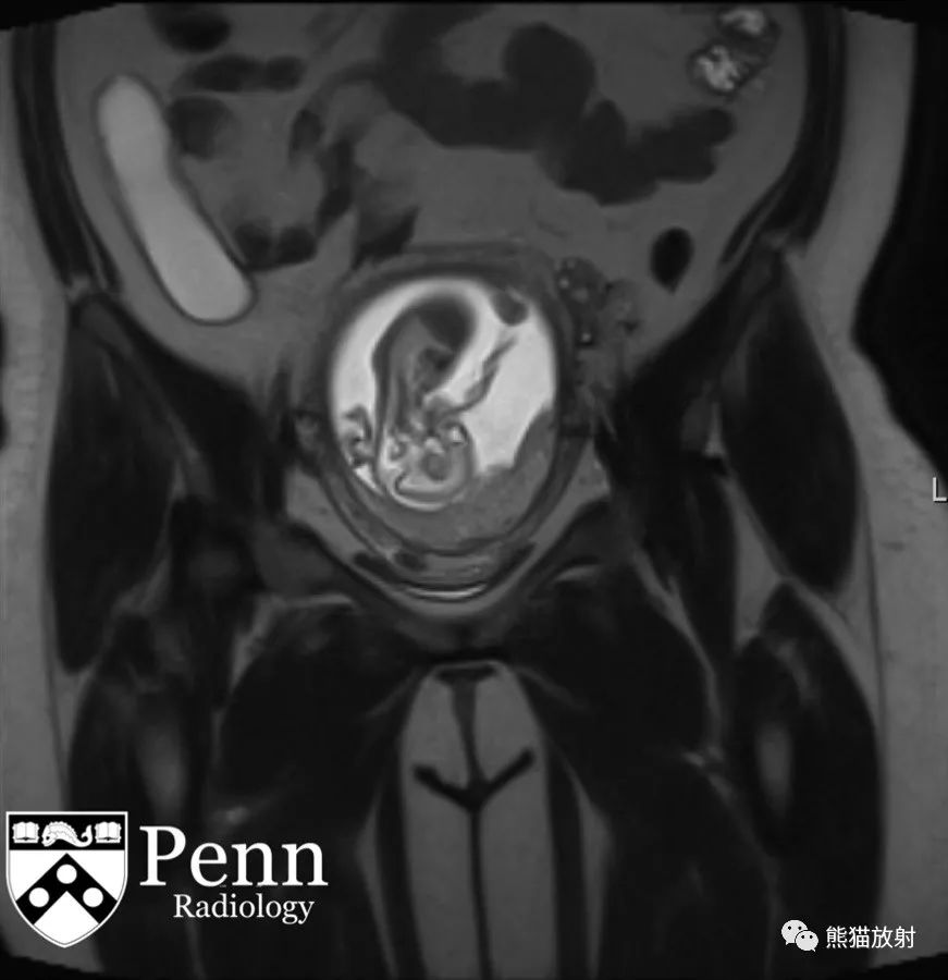 【病例】阑尾黏液囊肿1例MR影像表现 【病例】阑尾黏液囊肿1例MR影像表现