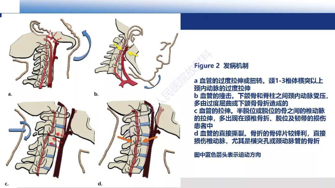 【PPT】头颈部血管钝性损伤影像诊断及治疗