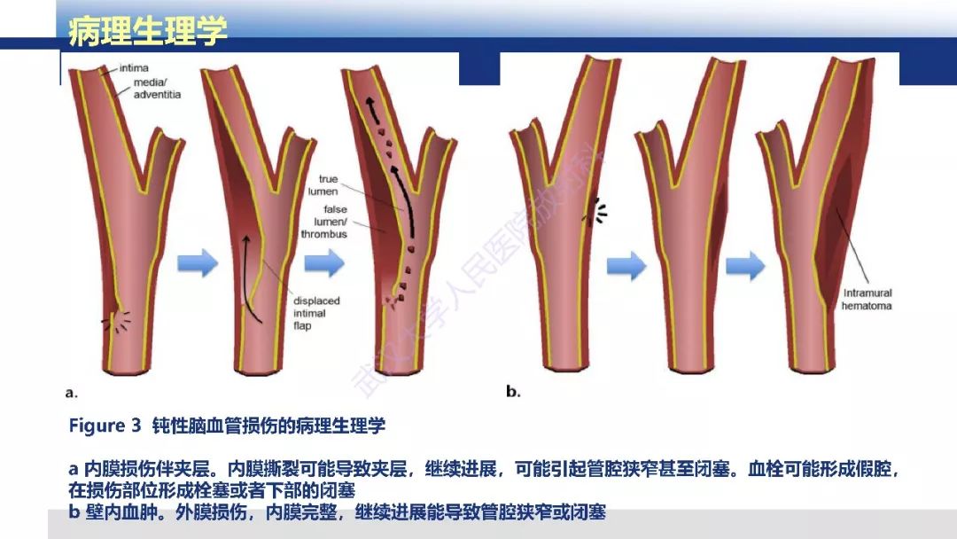 【PPT】头颈部血管钝性损伤影像诊断及治疗