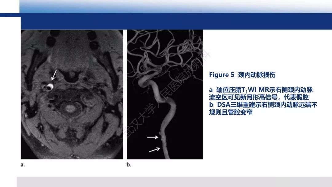 【PPT】头颈部血管钝性损伤影像诊断及治疗