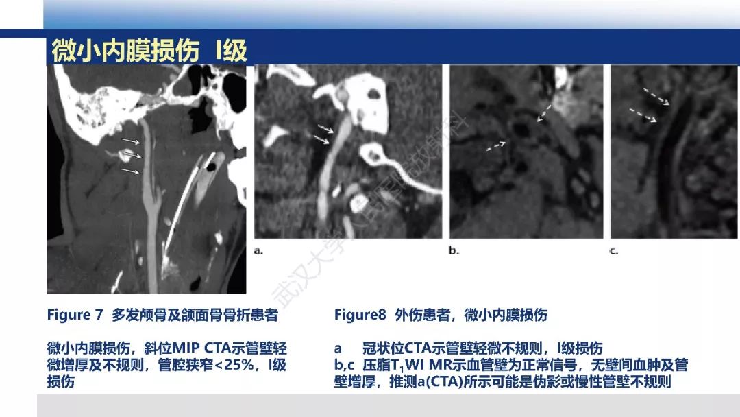 【PPT】头颈部血管钝性损伤影像诊断及治疗