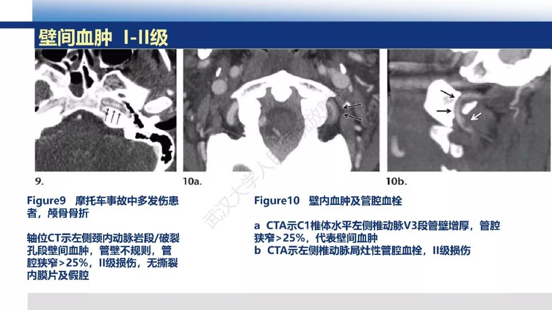 【PPT】头颈部血管钝性损伤影像诊断及治疗