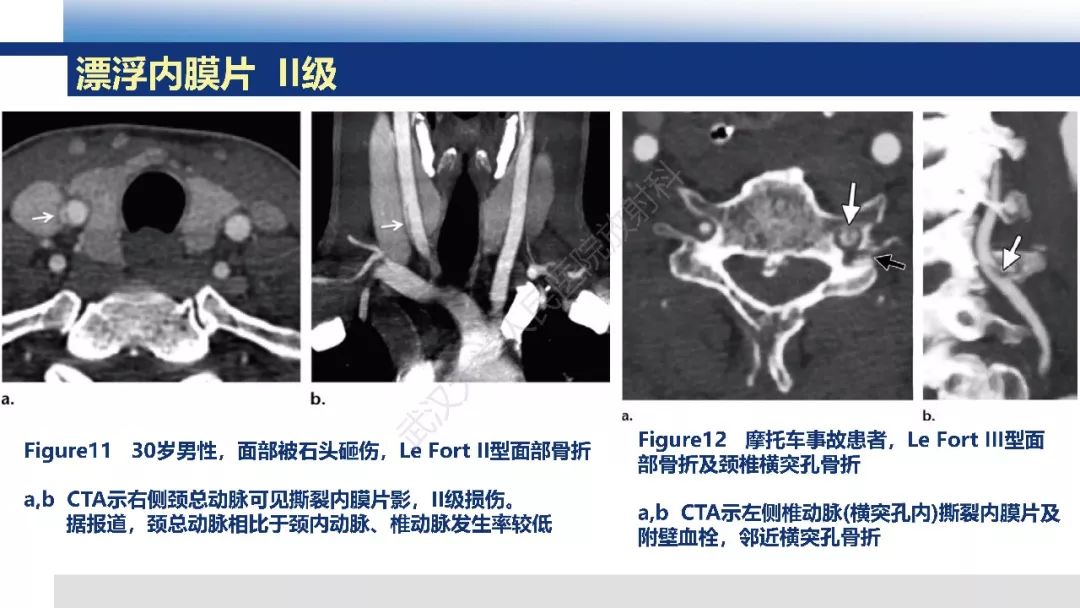 【PPT】头颈部血管钝性损伤影像诊断及治疗