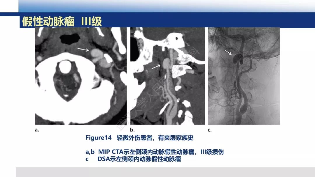 【PPT】头颈部血管钝性损伤影像诊断及治疗