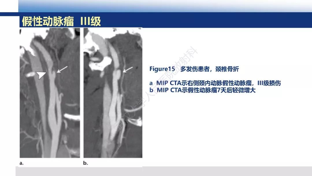 【PPT】头颈部血管钝性损伤影像诊断及治疗