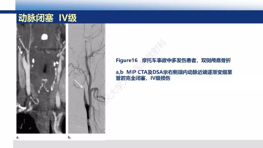 【PPT】头颈部血管钝性损伤影像诊断及治疗