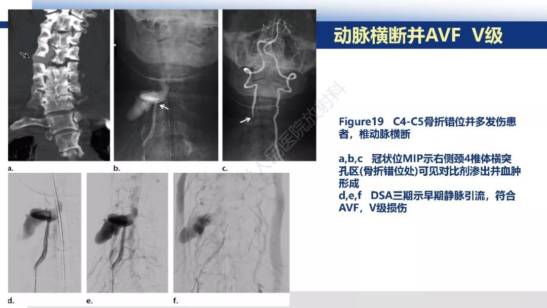 【PPT】头颈部血管钝性损伤影像诊断及治疗