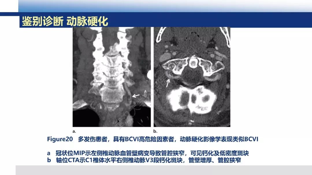 【PPT】头颈部血管钝性损伤影像诊断及治疗