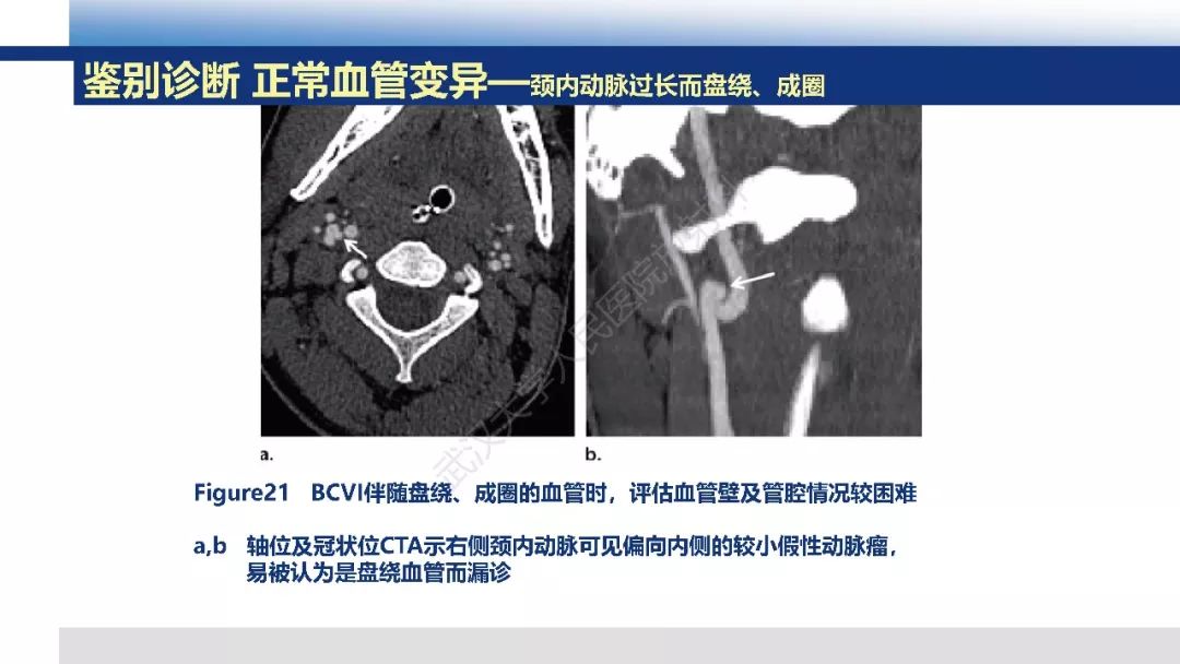 【PPT】头颈部血管钝性损伤影像诊断及治疗