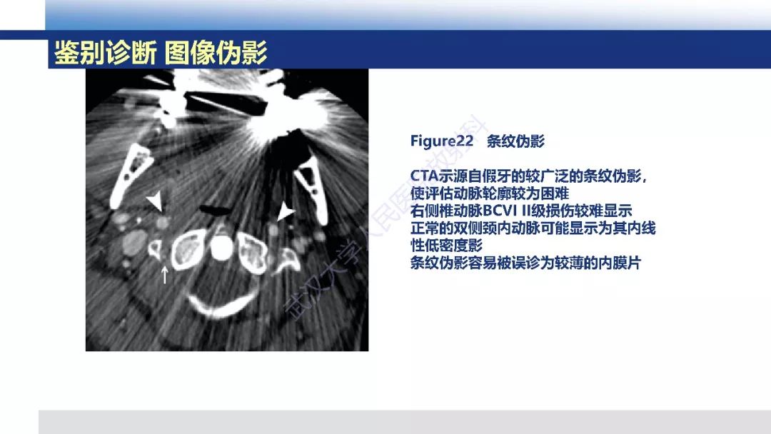 【PPT】头颈部血管钝性损伤影像诊断及治疗