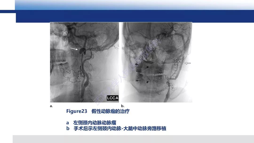 【PPT】头颈部血管钝性损伤影像诊断及治疗