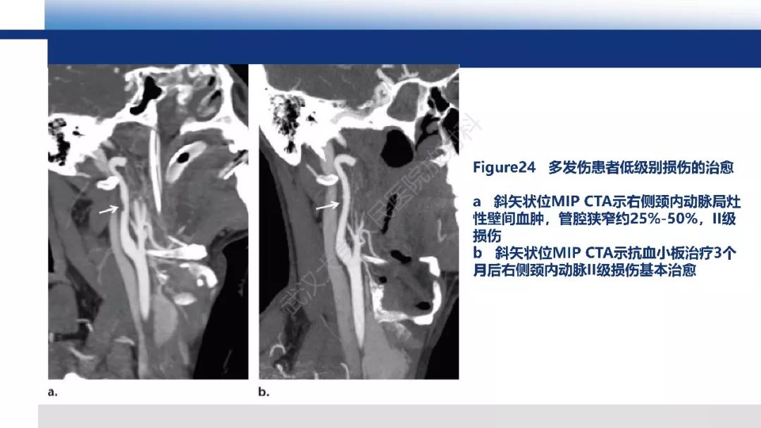 【PPT】头颈部血管钝性损伤影像诊断及治疗