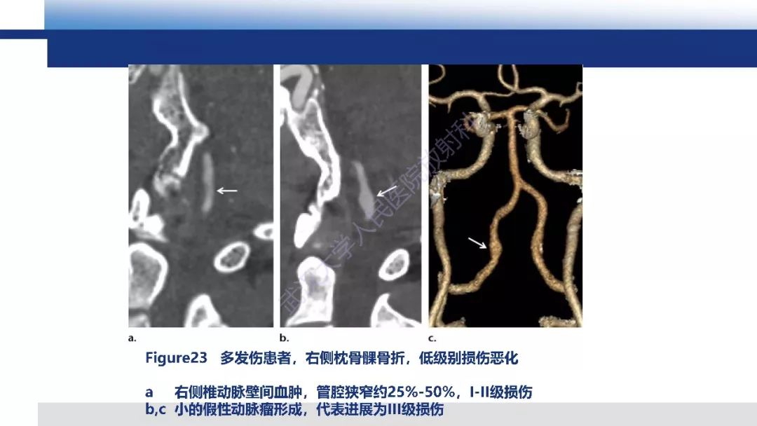 【PPT】头颈部血管钝性损伤影像诊断及治疗