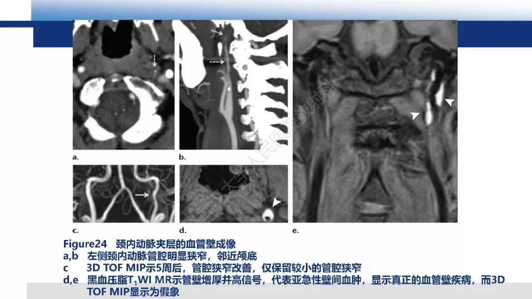 【PPT】头颈部血管钝性损伤影像诊断及治疗