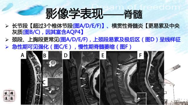 【病例】肠粘连束带腹内疝2例影像诊断