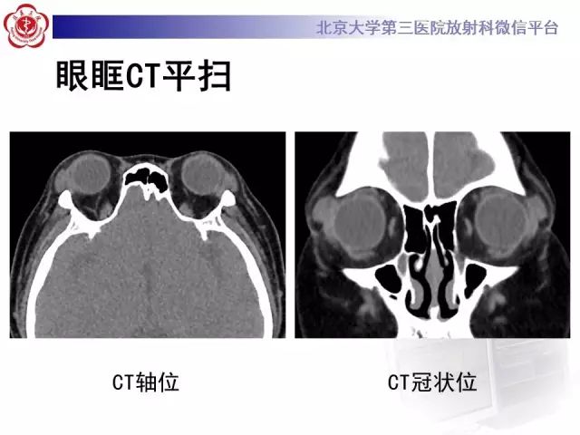 【病例】双侧泪腺脱垂1例CT
