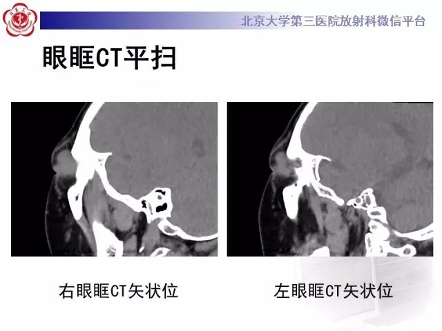【病例】双侧泪腺脱垂1例CT