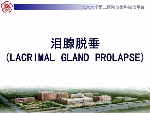 【病例】双侧泪腺脱垂1例CT