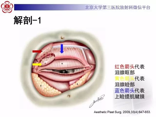 【病例】双侧泪腺脱垂1例CT