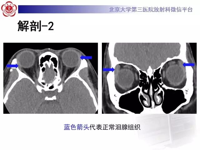【病例】双侧泪腺脱垂1例CT