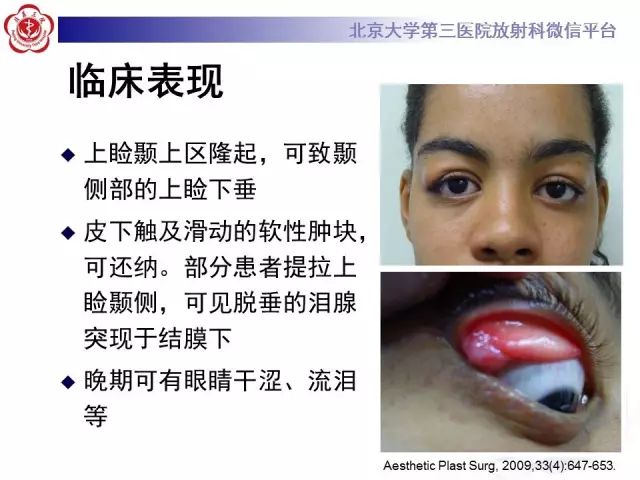 【病例】双侧泪腺脱垂1例CT