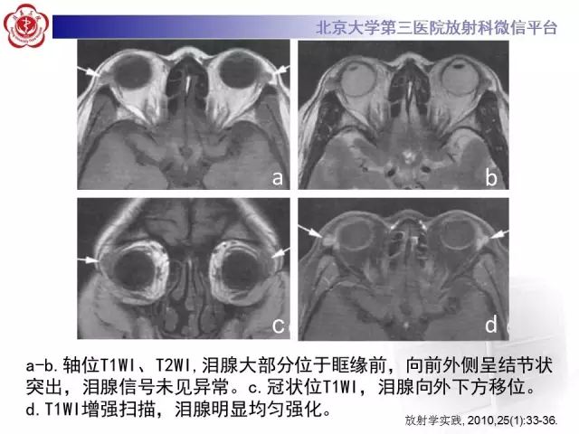 【病例】双侧泪腺脱垂1例CT