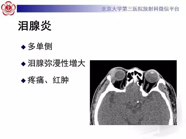 【病例】双侧泪腺脱垂1例CT