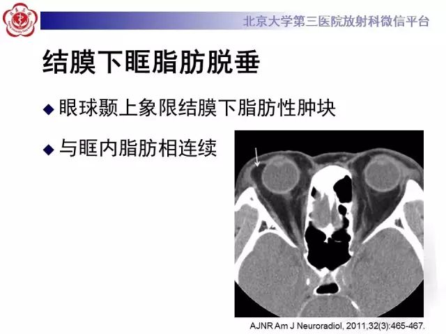 【病例】双侧泪腺脱垂1例CT